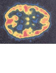 PET Scan